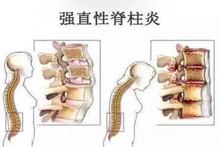 急性脊柱炎能治好吗：性别不限，治愈费用解析与治疗详情