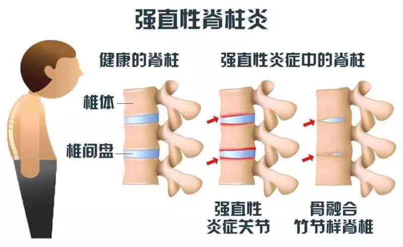 急性脊柱炎能治好吗：性别不限，治愈费用解析与治疗详情