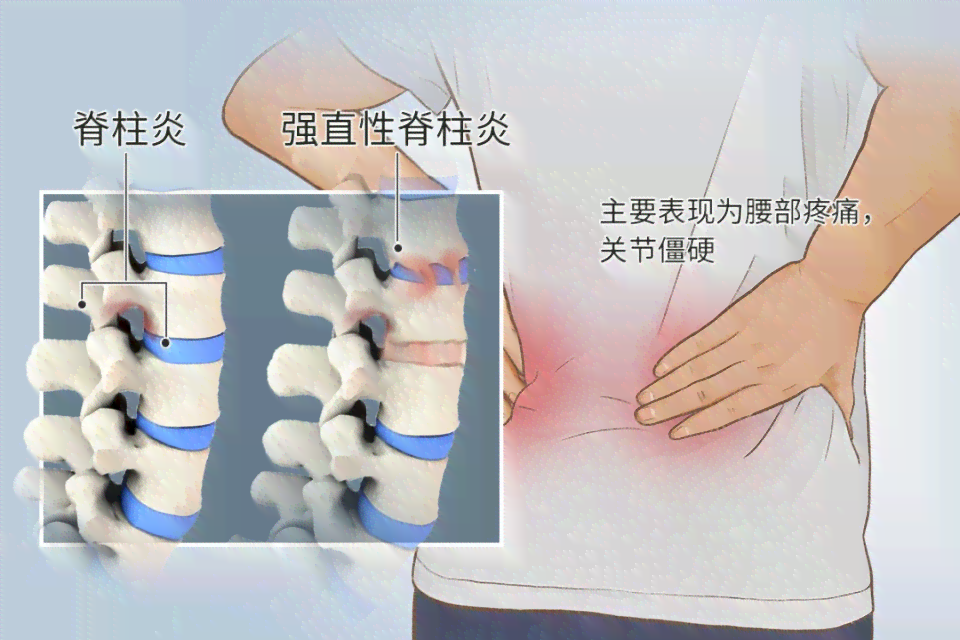 全面解析：急性脊柱炎症的成因、症状与治疗策略