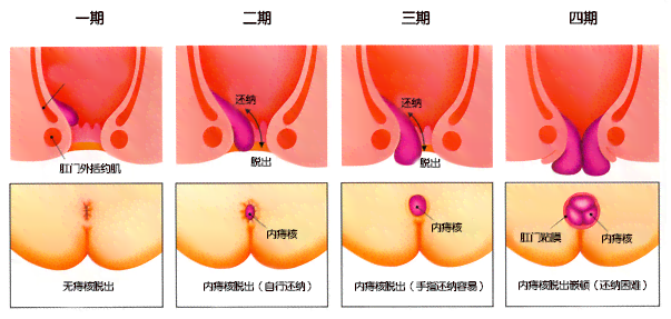 全面解析：急性脊柱炎症的成因、症状与治疗策略