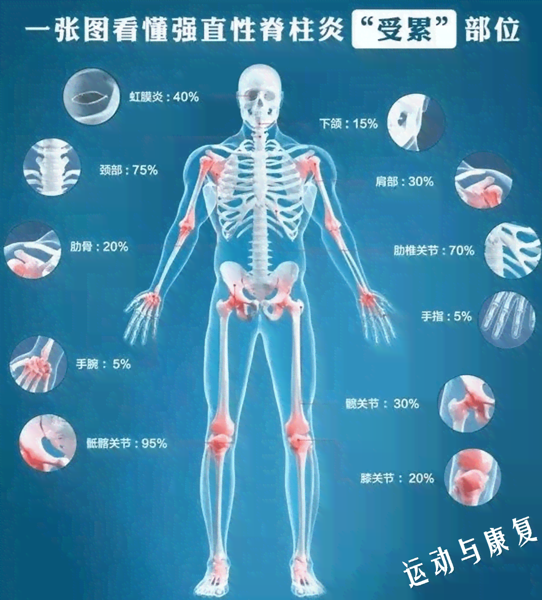急性脊柱炎能治好吗：男女性治愈可能性与费用分析