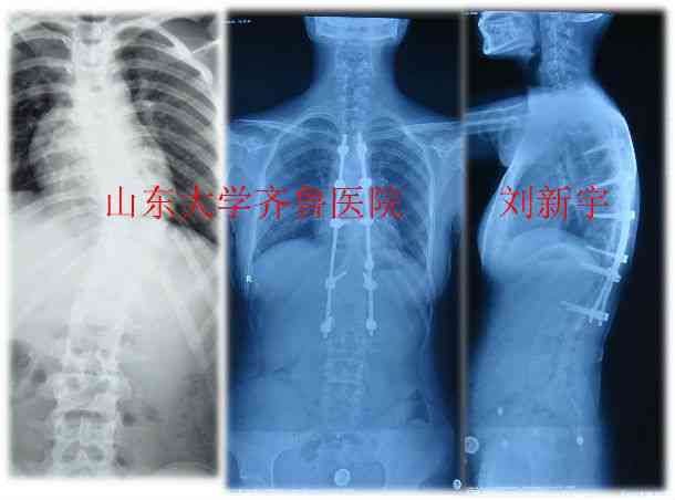 全面解读：急性脊柱炎症的成因、症状、诊断与治疗策略