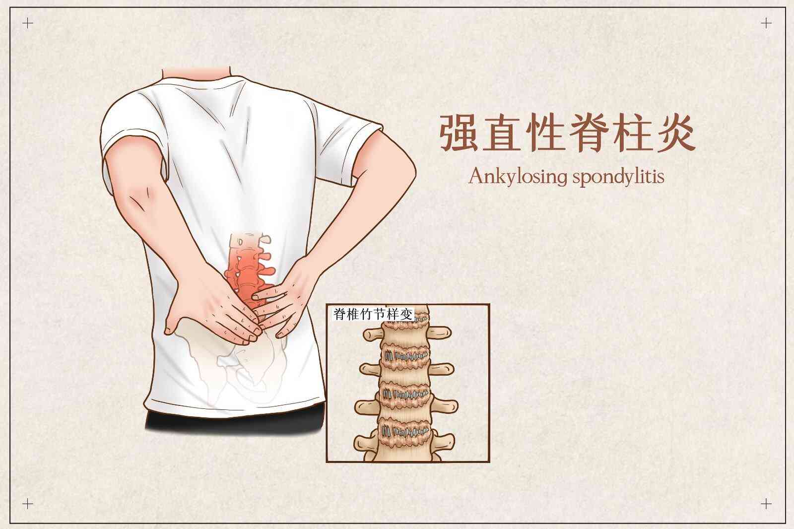 探索急性脊柱炎的治愈可能性与有效治疗策略