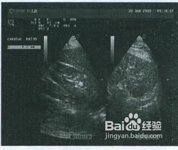 全面解读：急性脊柱炎症的成因、症状、诊断与治疗策略