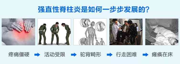 全面解读：急性脊柱炎症的成因、症状、诊断与治疗策略