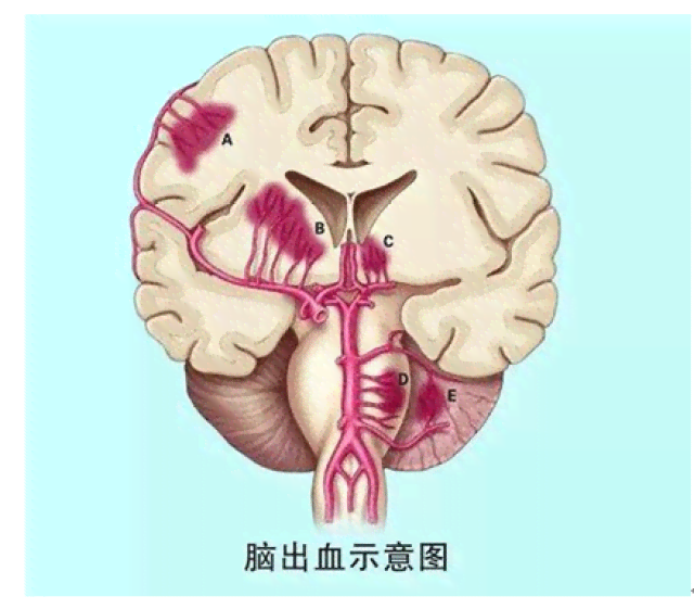 急性脑出血算不算重大疾病及报销范围，是否属于意外