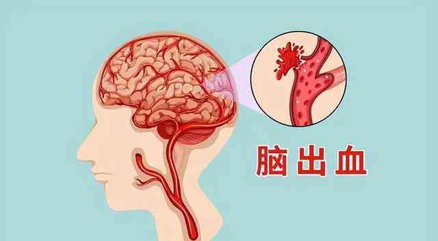 急性脑出血是否属于意外险理赔范围及其相关条款解读