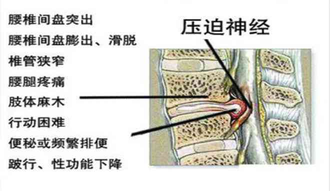工作中急性腰间盘突出：是否合工伤认定标准？