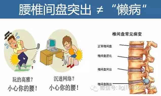 急性腰扭伤与腰椎间盘突出：工伤认定标准及申报流程详解