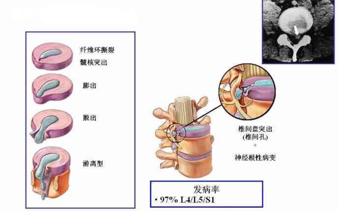 急性腰扭伤与腰椎间盘突出：工伤认定标准及申报流程详解