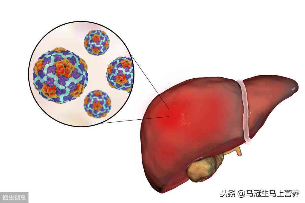 腰椎间盘突出急性期自愈可能性与家庭复方法解析