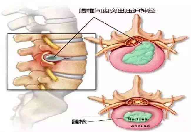 腰椎间盘突出急性期自愈可能性与家庭复方法解析