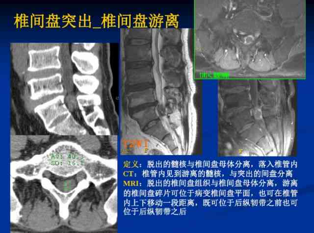 工伤急性腰椎间盘突出症诊断与治疗