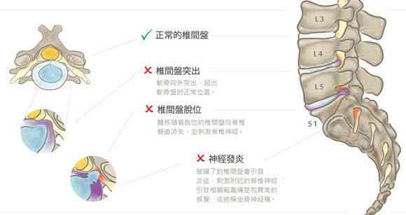 急性腰间盘突出算工伤吗：腰椎间盘突出急性扭伤能否认定工伤及影响工作情况