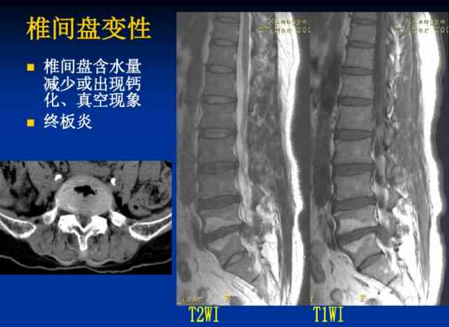 工伤急性腰椎间盘突出症诊断与治疗