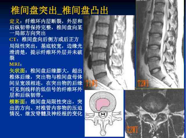 工伤急性腰椎间盘突出症诊断与治疗