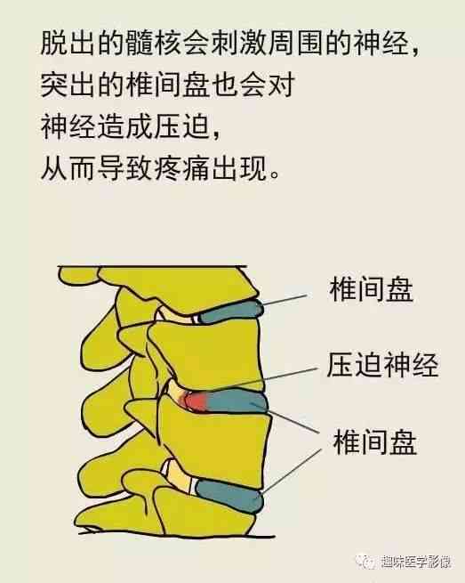 腰椎间盘突出症工伤鉴定：工伤等级划分及赔偿解析