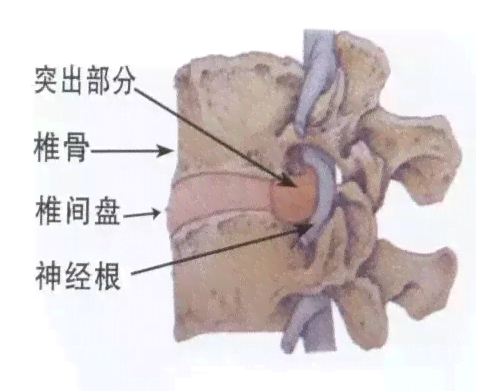 急性腰间盘突出认定工伤