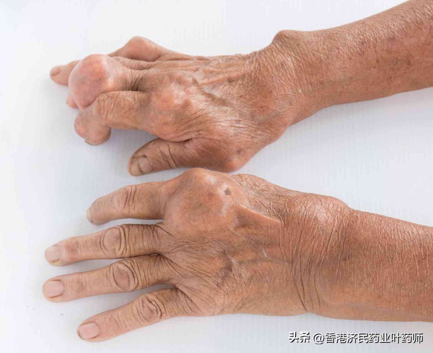 深入了解中度慢性炎症：含义、原因、症状及治疗全解析
