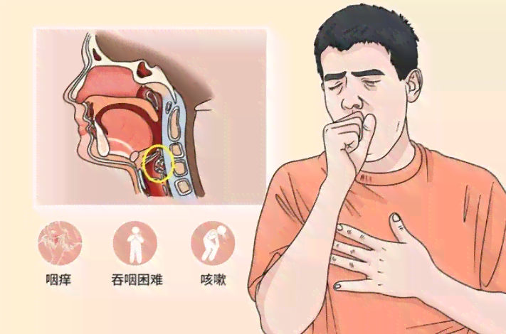 慢性咽炎能认定职业病吗：治疗与赔偿指南及认定标准