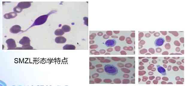 慢性白血病患者的工作能力与职业选择：全面指南与建议