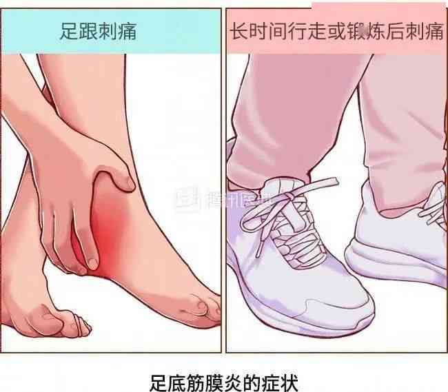 慢性筋膜炎复周期解析：治疗、锻炼与影响因素全解读