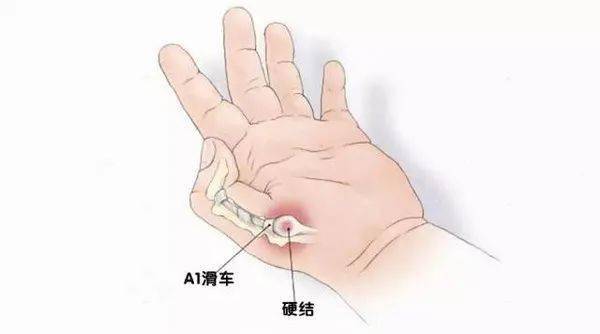 手关节脱位能认定工伤吗 手关节脱位能认定工伤吗