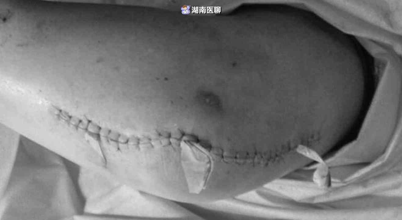 '手部创伤诊断：手打石膏确认骨折还是断裂情况'
