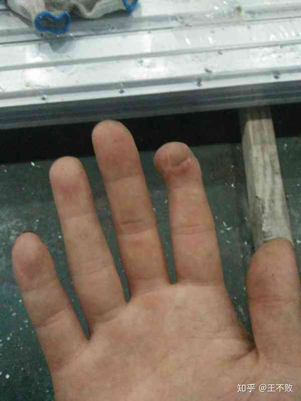 手指划伤工伤认定标准及常见疑问解答：如何判定和处理工作场所中的小伤小痛