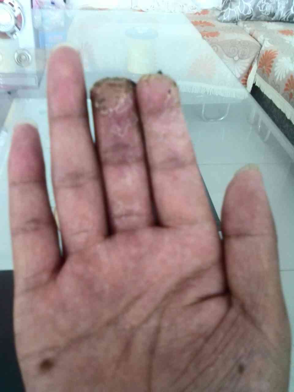 '手指变形：是否能认定为工伤伤残等级评定标准'