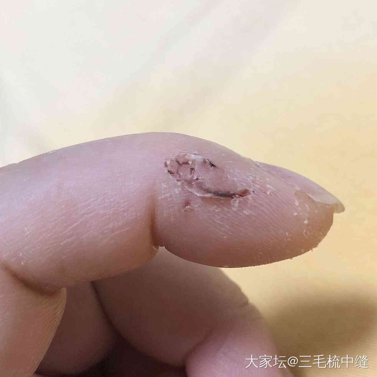 拆线后手指恢复期间如何安排工作与生活