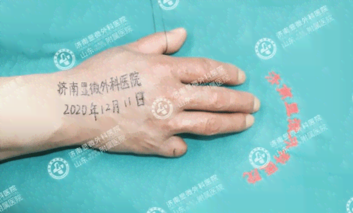 拆线后手指恢复期间如何安排工作与生活