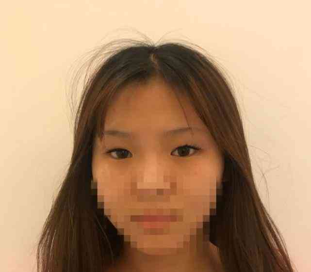 '手指拆线后是否能恢复至术前状态：探讨恢复原样的可能性'