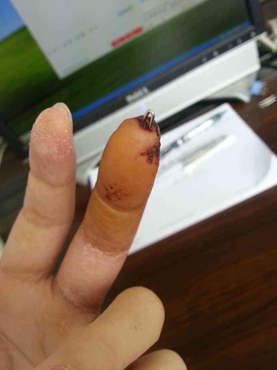 手指挤伤什么程度认定工伤