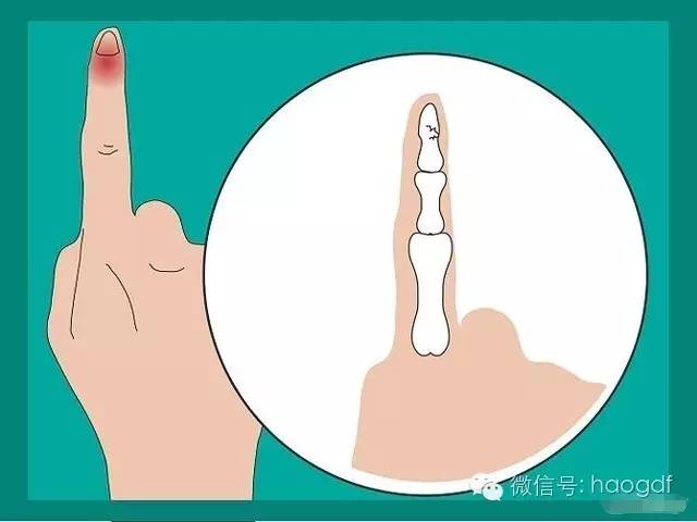 快速缓解手指挤伤疼痛的有效方法