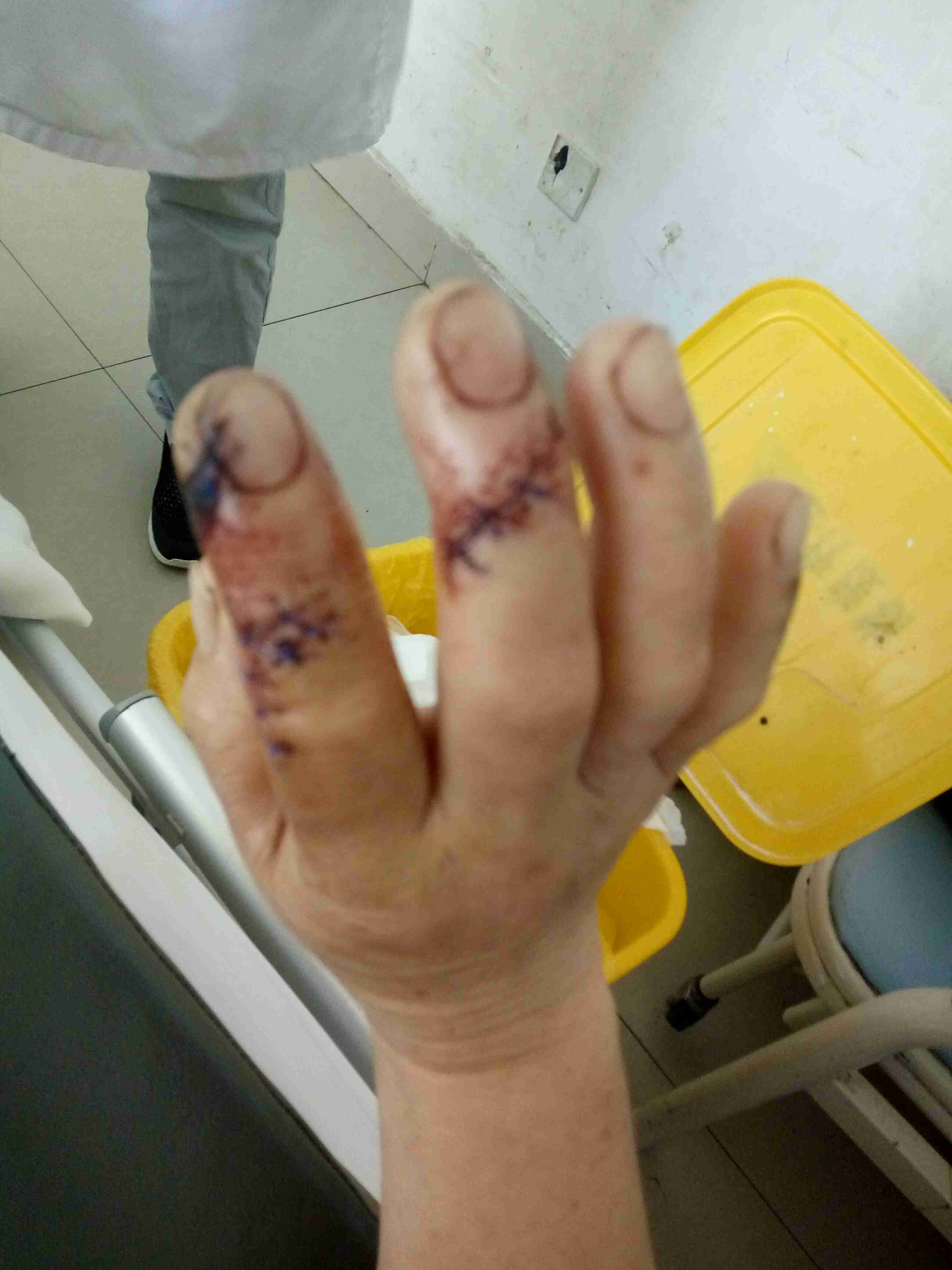 '一根手指断裂是否构成轻伤：法律角度解读'