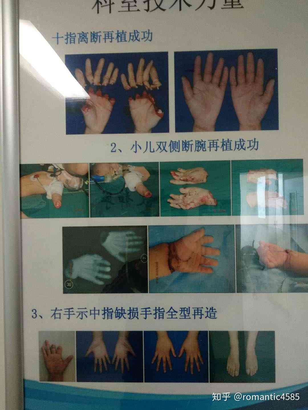 手指断一根认定工伤几级