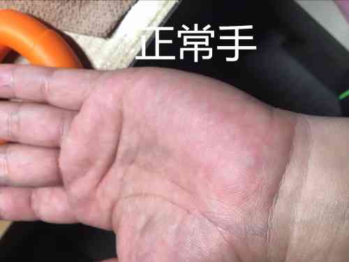 工伤手指断裂伤残等级判定标准及赔偿指南