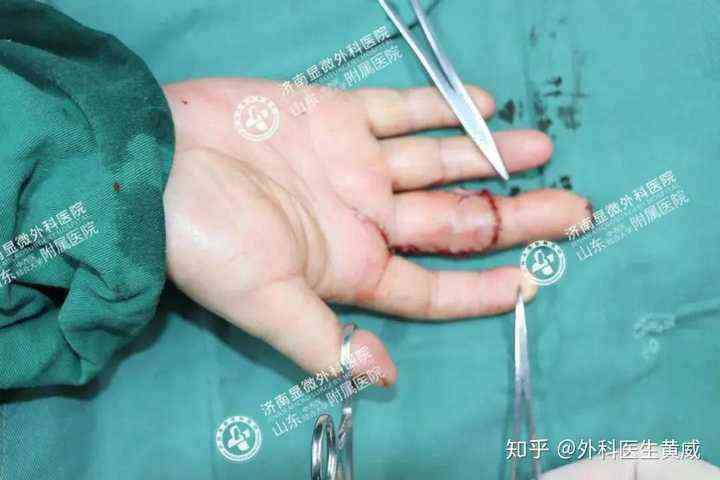 '工伤认定：手指植皮手术是否属于工伤情形解析'