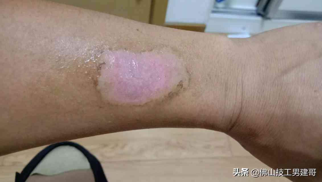 手指烫伤自愈的可能性与护理方法探究
