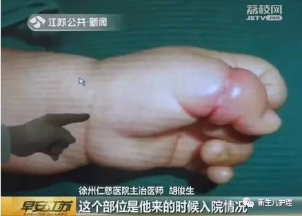 手指电击伤的严重程度评估：截肢是否必要及治疗对策分析