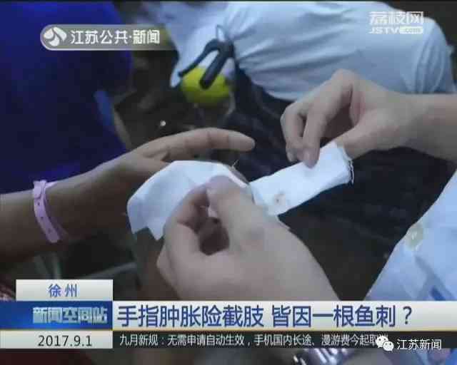 手指电击伤的严重程度评估：截肢是否必要及治疗对策分析
