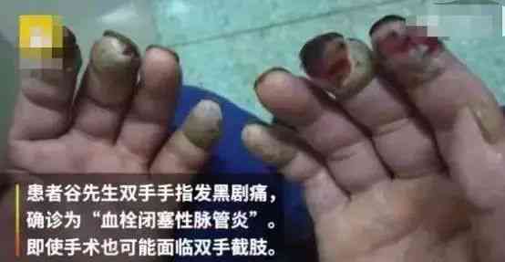 手指电击伤的严重程度评估：截肢是否必要及治疗对策分析