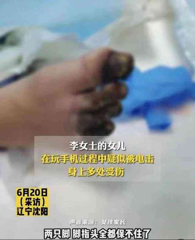 手指电击伤的严重程度评估：截肢是否必要及治疗对策分析