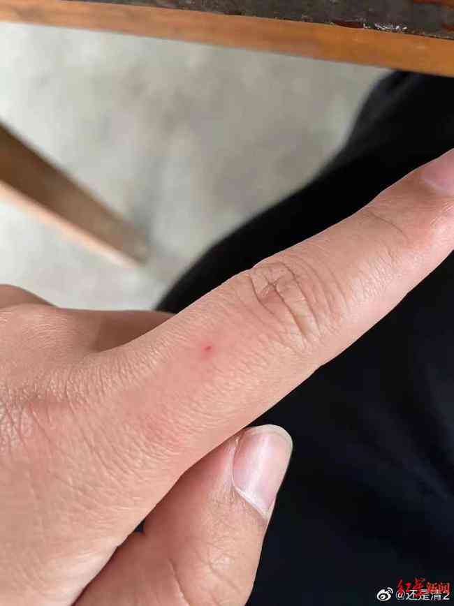手指缝线会不会留疤，缝线后出血正常吗，伤口多久愈合及护理要点