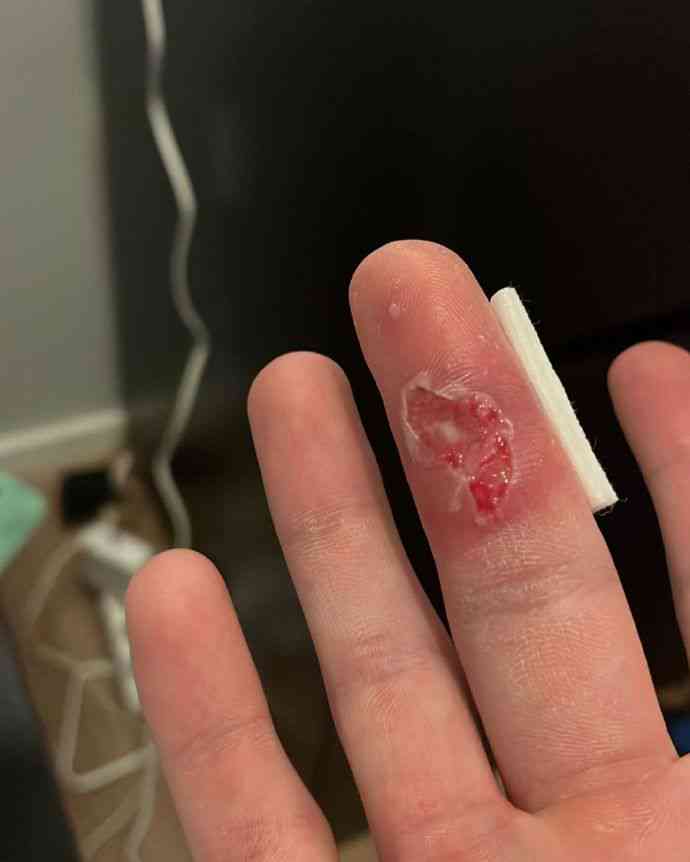 手指缝线会不会留疤，缝线后出血正常吗，伤口多久愈合及护理要点