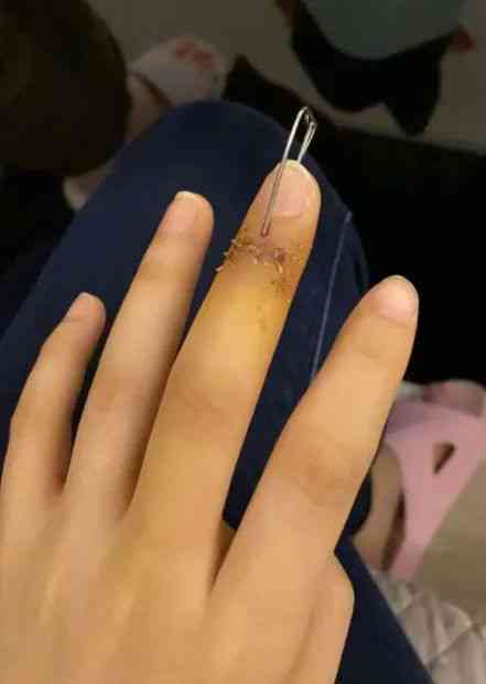 手指缝针事故工伤认定标准及赔偿金额详解