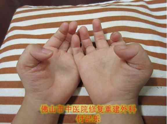 工伤认定：手指肌腱断裂赔偿标准与工伤待遇详解
