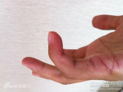 工伤认定：手指肌腱断裂赔偿标准与工伤待遇详解