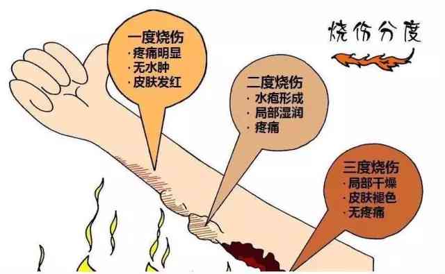 烧伤手指功能恢复的可能性与复方法探讨